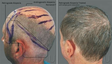 Patient Results Norwood 6 7 In Los Angeles Dr U Hair And Skin Clinic