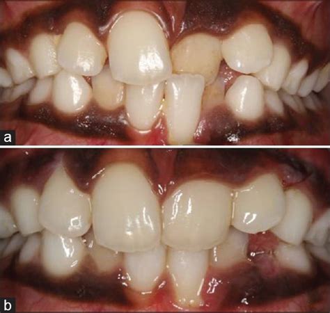 Correction Of Anterior Crossbite Using Modified Transparent Aligners