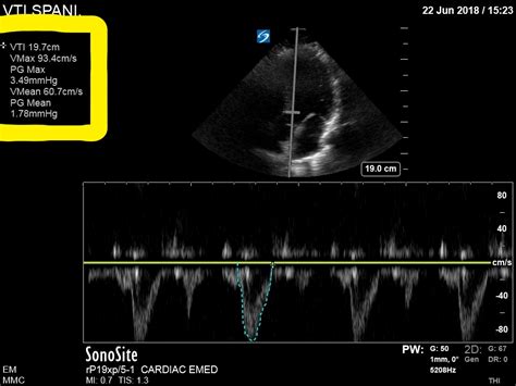 Velocity Time Integral Vti And The Passive Leg Raise Taking Volume