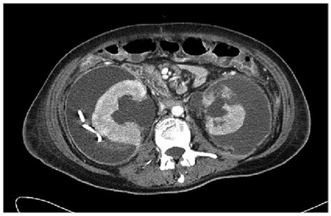 A Follow Up Computed Tomography Scan Weeks Subsequent To The