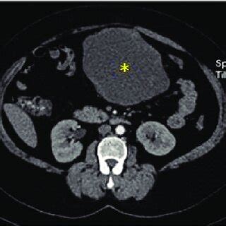 Contrast Enhanced Axial A C Ct Images Show An Exophytic