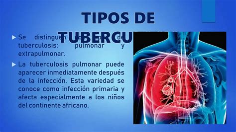 Tuberculosis Definici N Tipos Aaa Pptx