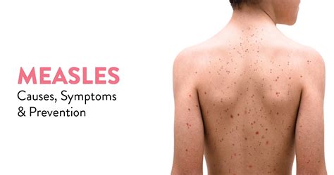 Measles Causes Symptoms And Prevention Ck Birla Hospital