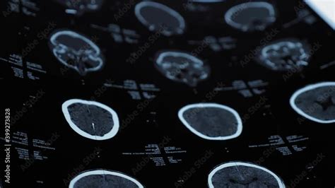 Magnetic Resonance Imaging Of An Older Man S Brain After A Traumatic