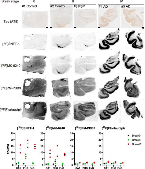 Novel Tau PET Tracer Exhibits High Sensitivity And Specificity Allows