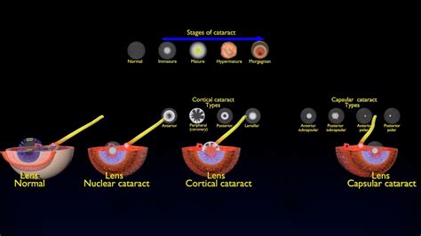 ArtStation - cataract types | Resources