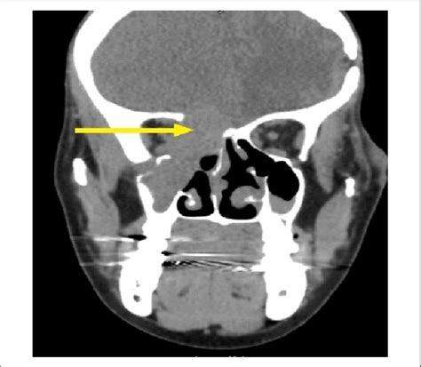 Computed Tomography Scan Of The Brain And Maxillary Sinus Mass With Download Scientific Diagram