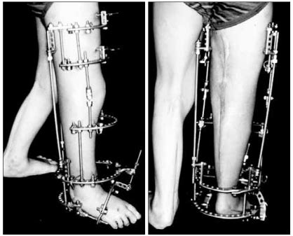 Photographs showing correction of the flexion contracture of the knee... | Download Scientific ...