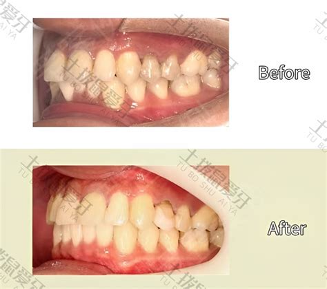 牙齿拥挤不拔牙矫正案例 土拨鼠爱牙