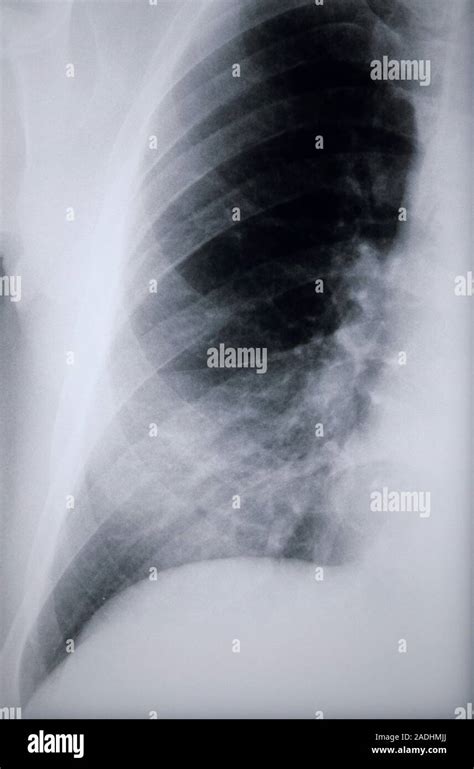 Pneumonia. X-ray of the lung of a 69 year old man showing pneumonia ...