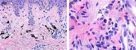 A Fixed Drug Eruption Dense Aggregate Of Melanophages In The