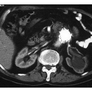 CT scanning one year after EVAR. (a) Migration of the endograft to the ...