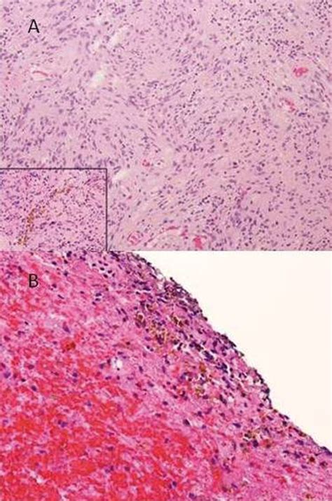 A Photomicrographs Showing That The Tumor Is Characterized By Closely