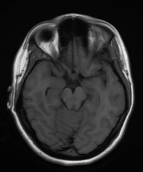 Arachnoid Granulation Straight Sinus Image