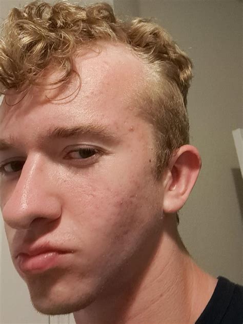 How Do I Fix My Bad Receding Hairline At The Age Of 16 R Malehairadvice