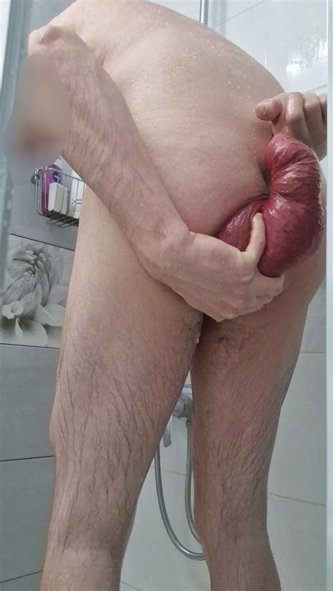 Biggest Anal Prolapse 1