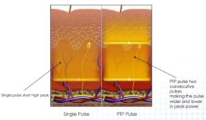 All You Need To Know About Revlite Laser Theme Dermatology