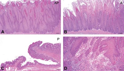 Vaginal Candidiasis Histology