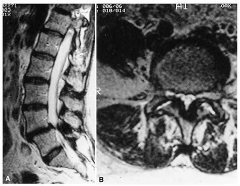 Approach to the Patient with Low Back Pain, Lumbosacral Radiculopathy ...