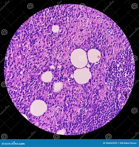 Thyroid Cancer Microscopic Image Of Metastatic Papillary Carcinoma Of