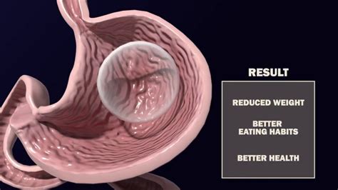 Intragastric Balloon Procedure By Jeong Jin Lee Youtube