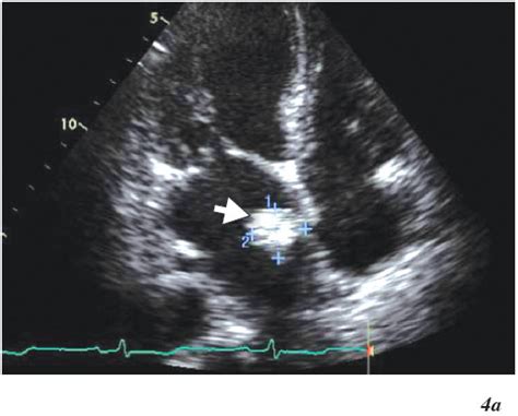 Cardiac Tumors