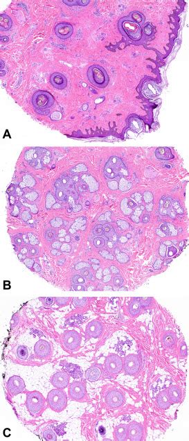 The Role Of The Scalp Biopsy In The Evaluation Of Alopecia Journal Of