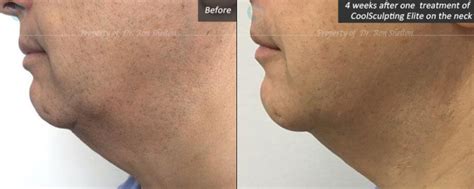 Before And After Coolsculpting Procedure In Nyc By Dr Ron Shelton