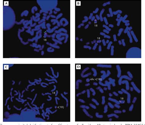 Figure 5 From Mosaic Ring Chromosome 18 Ring Chromosome 18 Duplication Deletion And Disomy 18