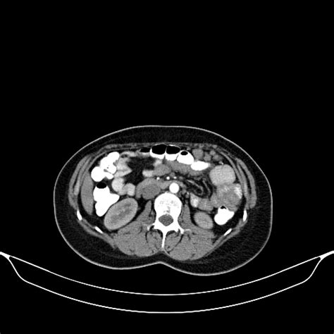 Splenosis Image