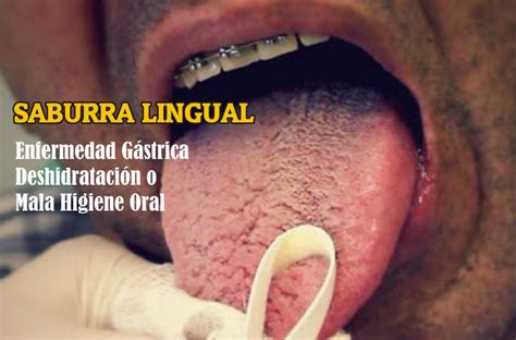 Como Curar La Lengua Blanca Sale Dakora Co