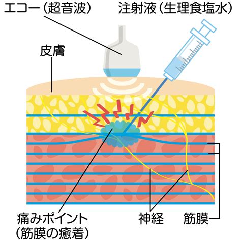 あなたの筋膜が健康かどうかをチェック！／痛みと筋膜のメカニズムを知る（後）