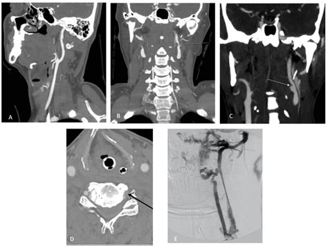 Blunt Cerebrovascular Injury Neuropedia Cerebrovascular