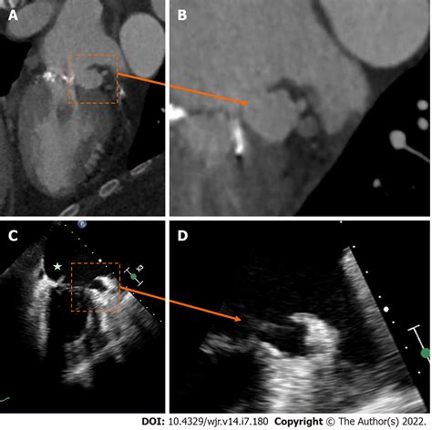 Infective Endocarditis Echo