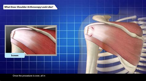 Shoulder Arthroscopy Practice Potential Youtube