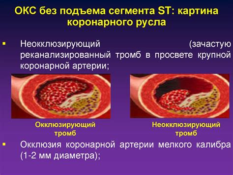 Острый коронарный синдром - презентация онлайн