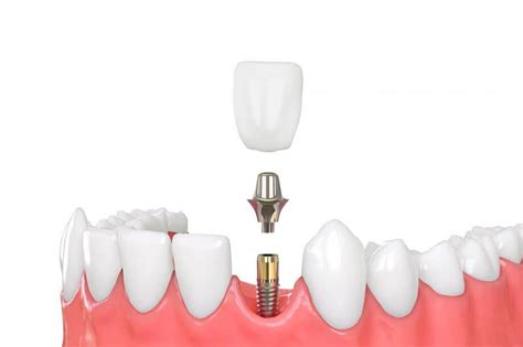 Dental Implant and Crown: Is This Combination Right for You?