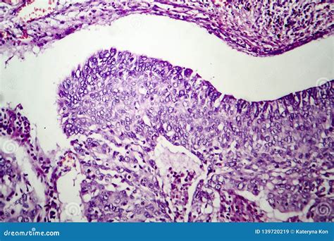 Lung Adenocarcinoma Light Micrograph Stock Image Image Of Pulmonary