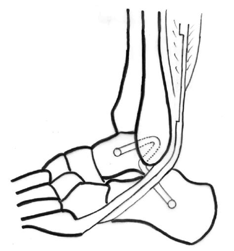 Schematic diagram showing lateral ankle ligament reconstruction using... | Download Scientific ...