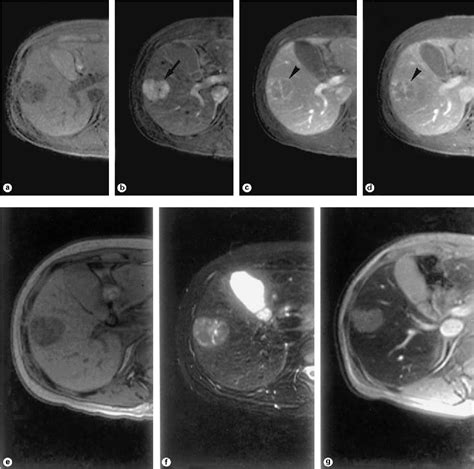 Figure 2 From Ct Scan And Mri In The Differentiation Of Liver Tumors Semantic Scholar