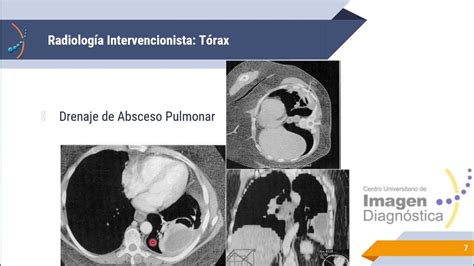 Radiología Intervencionista YouTube