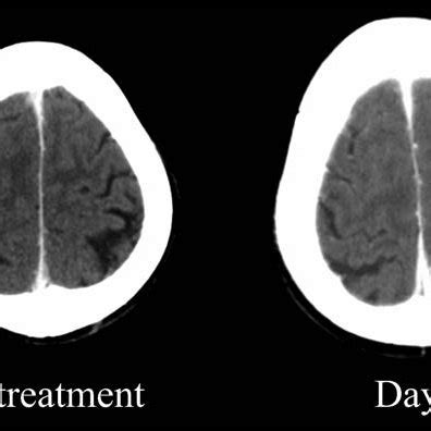 Contrast Enhanced Axial Brain Ct Images Of Case Multiple Metastases