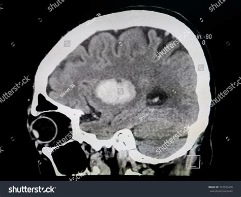 Ct Scan Brain Showing Intracerebral Haemorrhage Stock Photo Edit Now