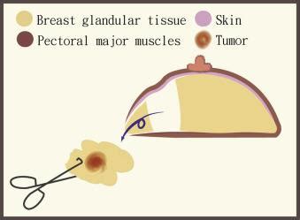 Minimally Invasive Breast SurgeryA Step By Step Graphic Illustrations