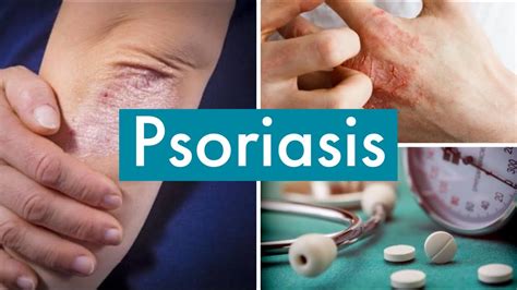 Tout Savoir Sur Le Psoriasis - Image to u
