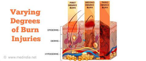 Pain Management for Burn Injuries