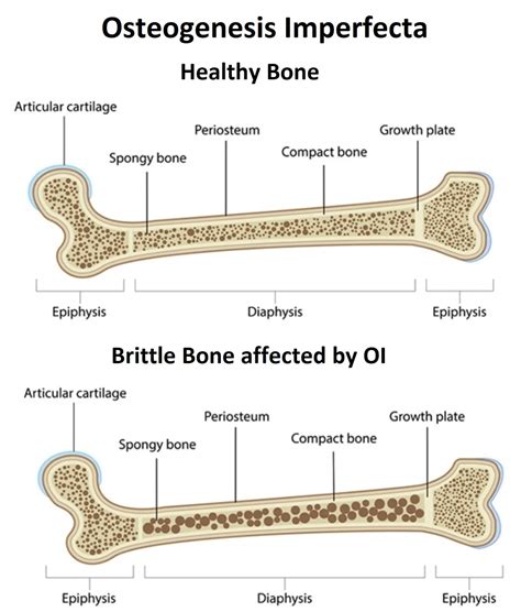 Osteogenesis Imperfecta | News | Dentagama