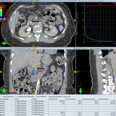 Treatment Plan For A Patient Treated With Sbrt To A Dose Of Gy