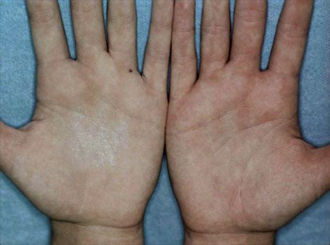 Unilateral Aquagenic Wrinkling Of The Palms Associated With Aspirin