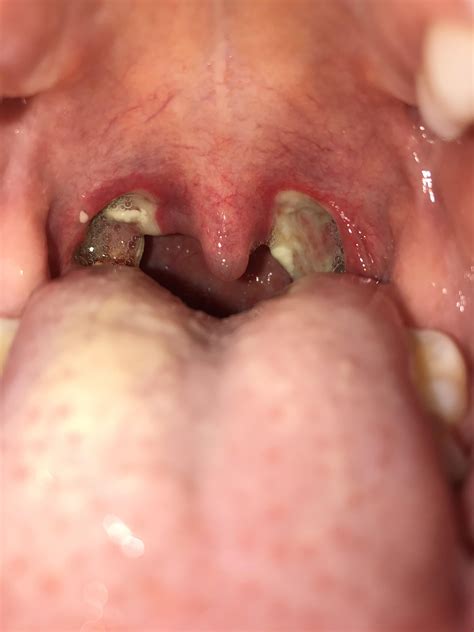 Tonsillectomy Healing Rmedicalgore